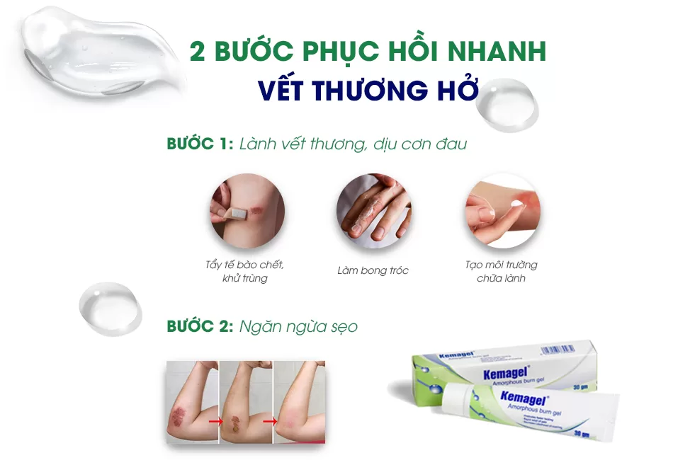 Kemagel là thuốc gì?